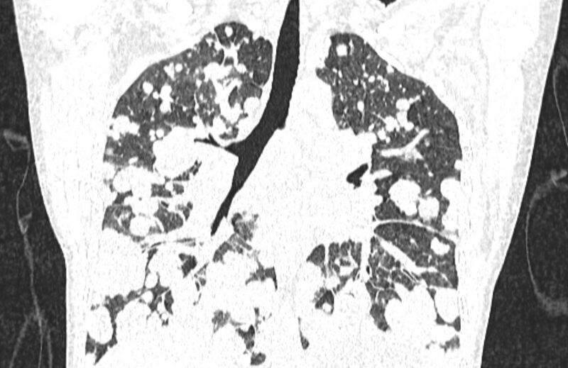 File:Cannonball metastases from breast cancer (Radiopaedia 91024-108569 Coronal lung window 81).jpg
