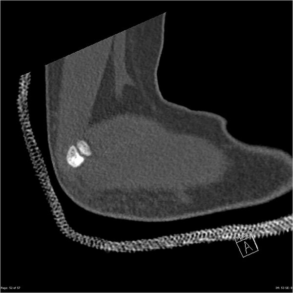 File:Capitellum fracture (Radiopaedia 23352-23426 Sagittal bone window 52).jpg