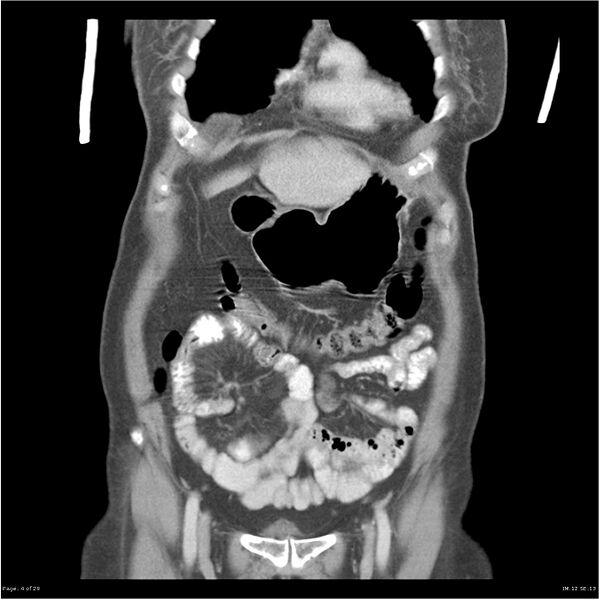File:Carcinoid tumor of the ileum with metastasis to orbit (Radiopaedia 28165-28425 B 4).jpg
