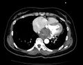 Cardiac rhabdomyosarcoma (Radiopaedia 11277).jpg