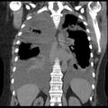 Cardiogenic pulmonary edema (Radiopaedia 29213-29609 Coronal non-contrast 29).jpg