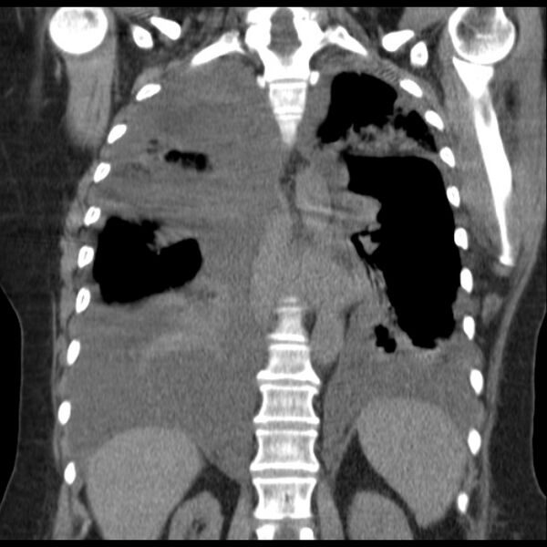 File:Cardiogenic pulmonary edema (Radiopaedia 29213-29609 Coronal non-contrast 29).jpg