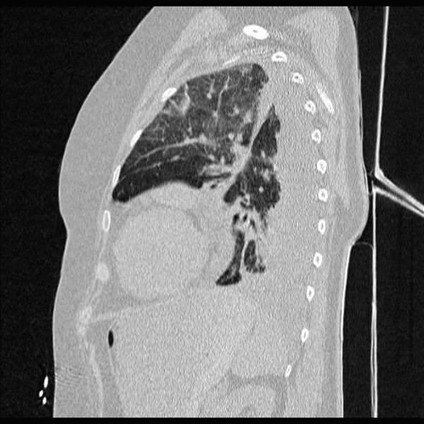File:Cardiogenic pulmonary edema (Radiopaedia 29213-29609 Sagittal lung window 71).jpg