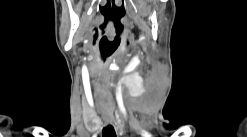 File:Carotid artery pseudoaneurysm (Radiopaedia 84030-99259 D 43).jpg