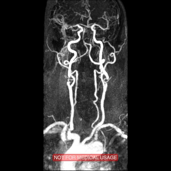 File:Carotid artery stenosis (Radiopaedia 28786-29087 3D MRA 7).jpg