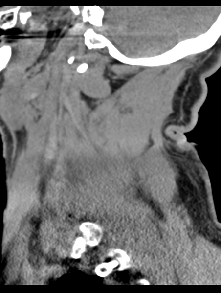 File:Cavernoma of cervical cord (Radiopaedia 50838-56346 B 19).png