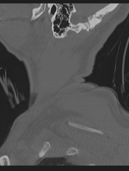 File:Cavernoma of cervical cord (Radiopaedia 50838-56346 Sagittal bone window 2).png