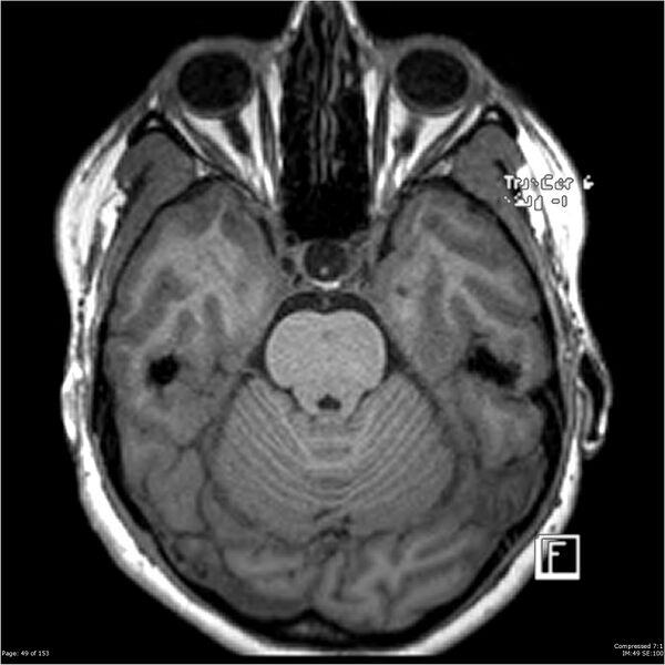 File:Cavernous malformation (cavernous angioma or cavernoma) (Radiopaedia 36675-38237 Axial T1 38).jpg