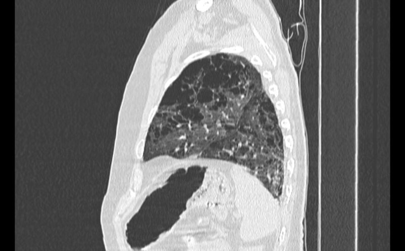 File:Cavitating bronchogenic carcinoma (Radiopaedia 44489-48162 Sagittal lung window 56).jpg