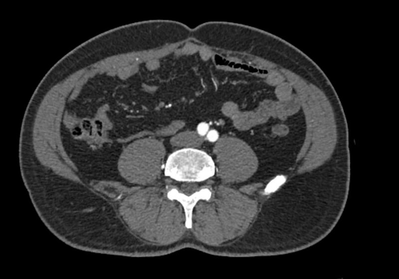 File:Celiac artery dissection (Radiopaedia 52194-58080 A 71).jpg