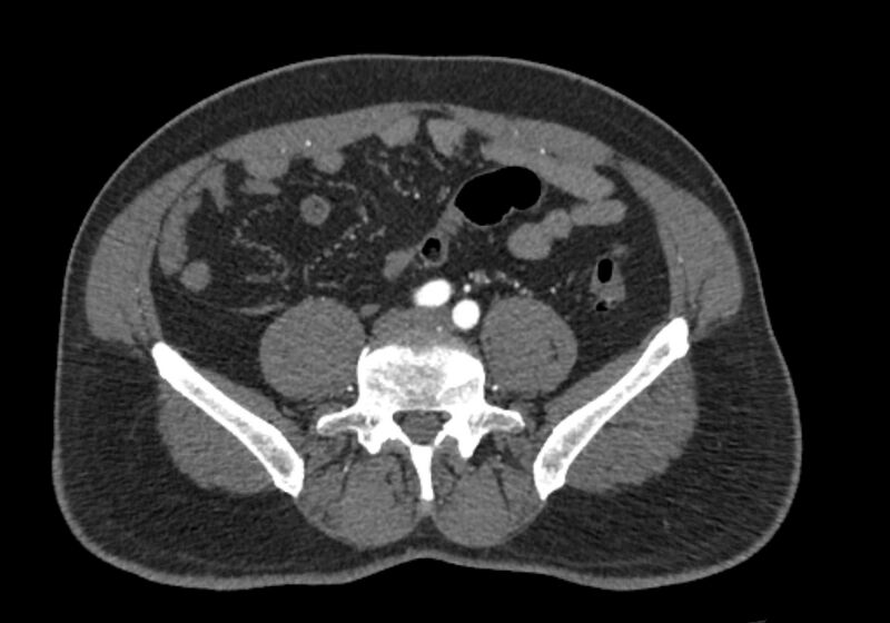 File:Celiac artery dissection (Radiopaedia 52194-58080 A 77).jpg