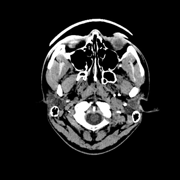 File:Central neurocytoma (Radiopaedia 79320-92379 Axial non-contrast 1).jpg