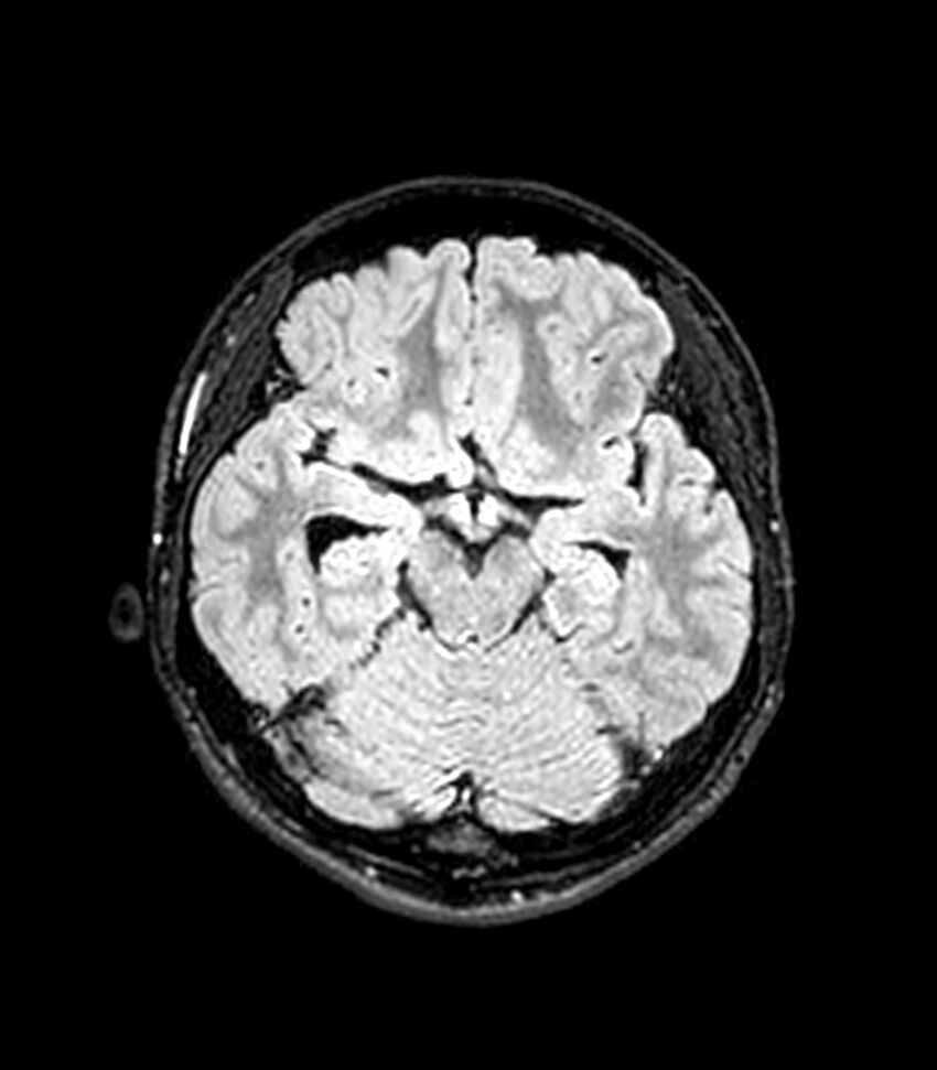 Central neurocytoma (Radiopaedia 79320-92380 Axial FLAIR 195).jpg