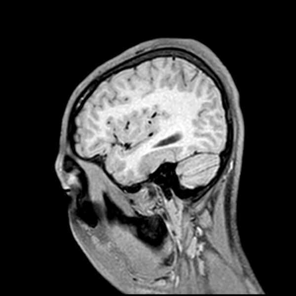 File:Central neurocytoma (Radiopaedia 79320-92380 Sagittal T1 203).jpg