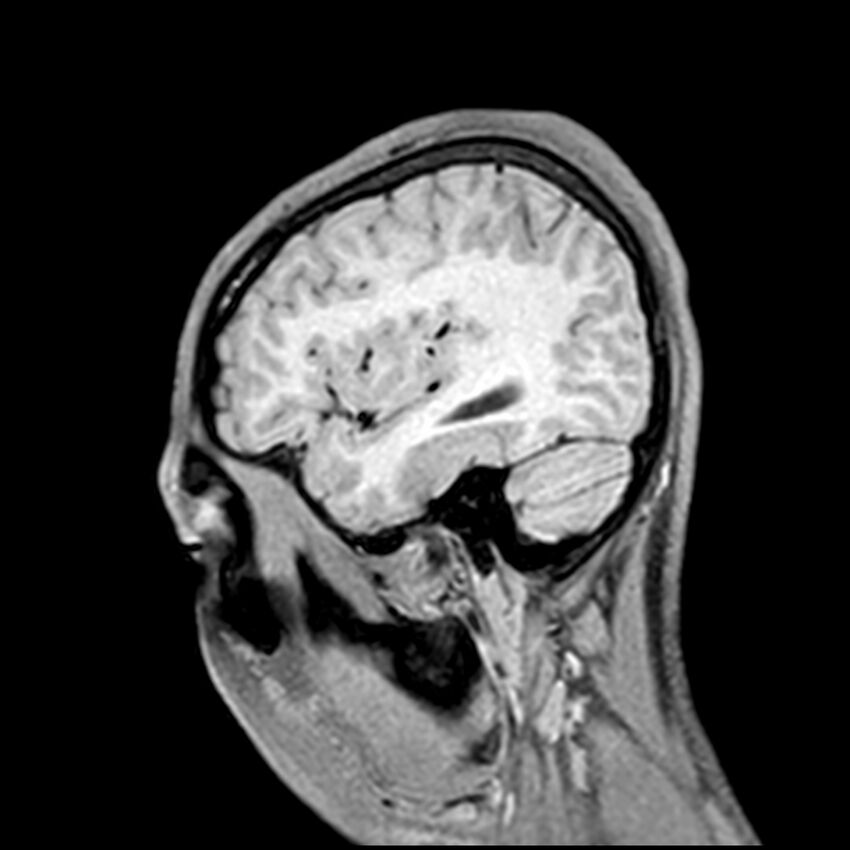 Central neurocytoma (Radiopaedia 79320-92380 Sagittal T1 203).jpg