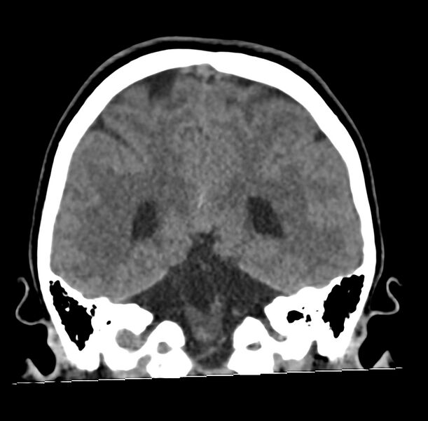 File:Cerebellar agenesis (Radiopaedia 30203-30817 Coronal non-contrast 30).jpg