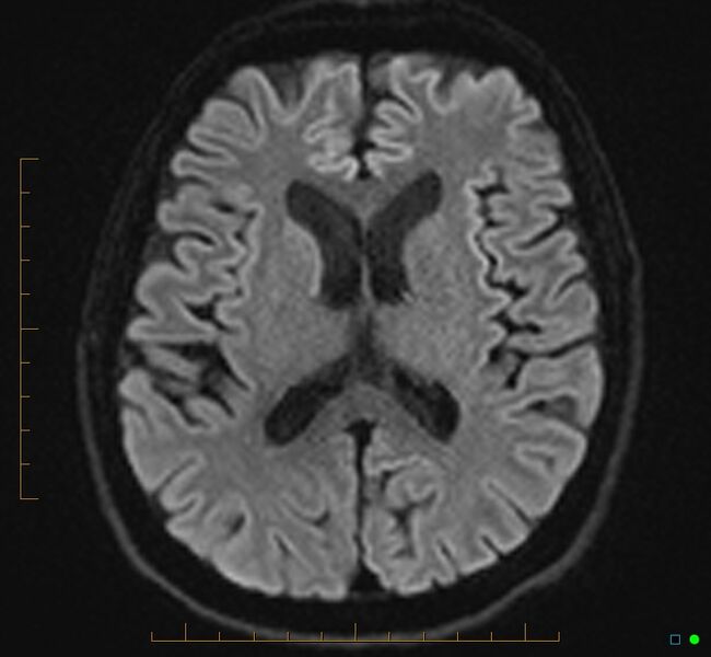 File:Cerebellar gangliocytoma (Radiopaedia 65377-74422 Axial DWI 22).jpg