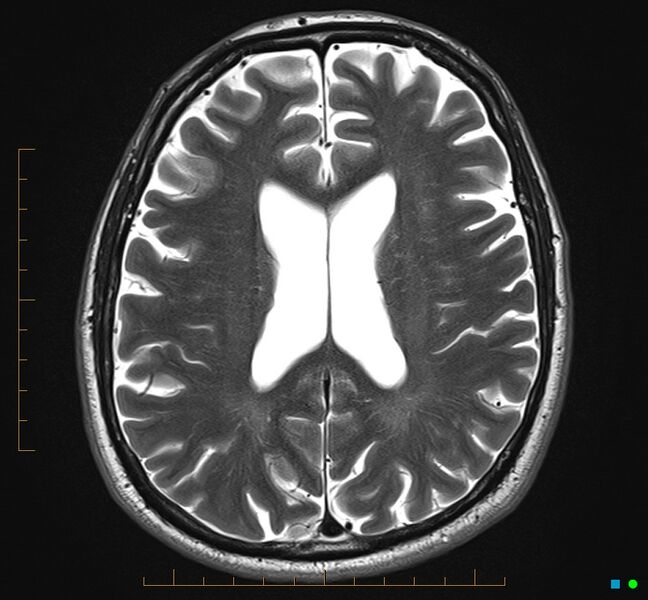File:Cerebellar gangliocytoma (Radiopaedia 65377-74422 Axial T2 24).jpg