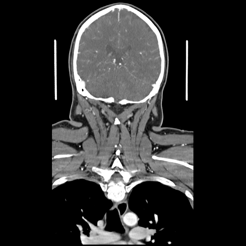 Cerebellar infarct due to vertebral artery dissection with posterior fossa decompression (Radiopaedia 82779-97029 D 43).png