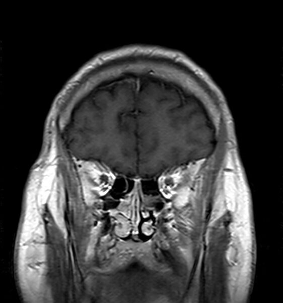 File:Cerebellopontine angle meningioma (Radiopaedia 24459-24764 Coronal T1 C+ 3).jpg