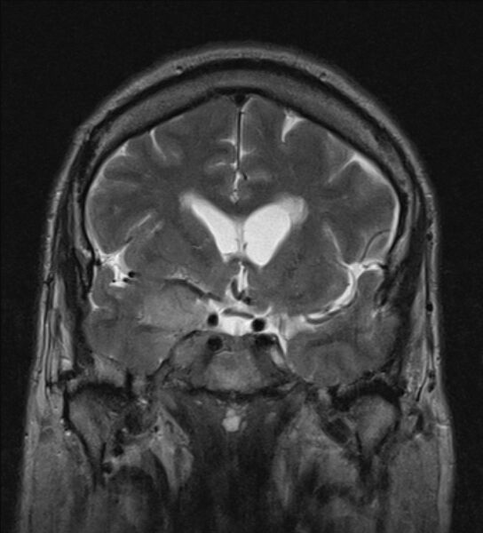 File:Cerebellopontine angle meningioma (Radiopaedia 24459-24764 Coronal T2 8).jpg
