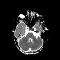 Cerebral abscess post cardiac surgery (Radiopaedia 27244-27420 Axial ADC 6).jpg