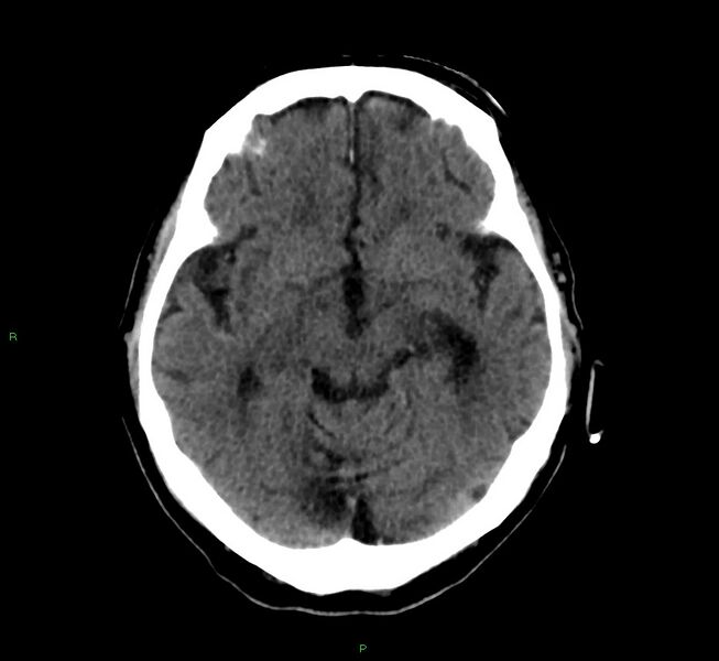 File:Cerebral amyloid angiopathy-associated lobar intracerebral hemorrhage (Radiopaedia 58376-65513 Axial non-contrast 32).jpg