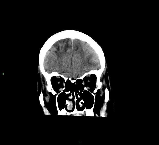 File:Cerebral amyloid angiopathy-associated lobar intracerebral hemorrhage (Radiopaedia 58529-65681 Coronal non-contrast 52).jpg