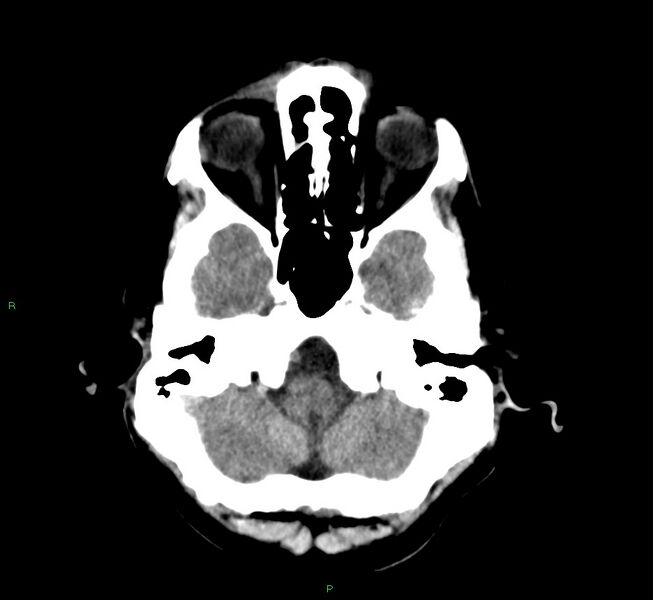 File:Cerebral amyloid angiopathy-associated lobar intracerebral hemorrhage (Radiopaedia 58529-65686 Axial non-contrast 4).jpg