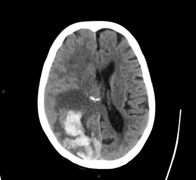 File:Cerebral amyloid angiopathy-associated lobar intracerebral hemorrhage (Radiopaedia 58563-65727 Axial non-contrast 25).jpg