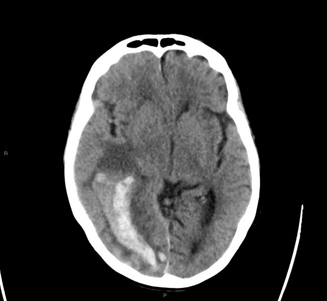 File:Cerebral amyloid angiopathy-associated lobar intracerebral hemorrhage (Radiopaedia 58563-65727 Axial non-contrast 31).jpg