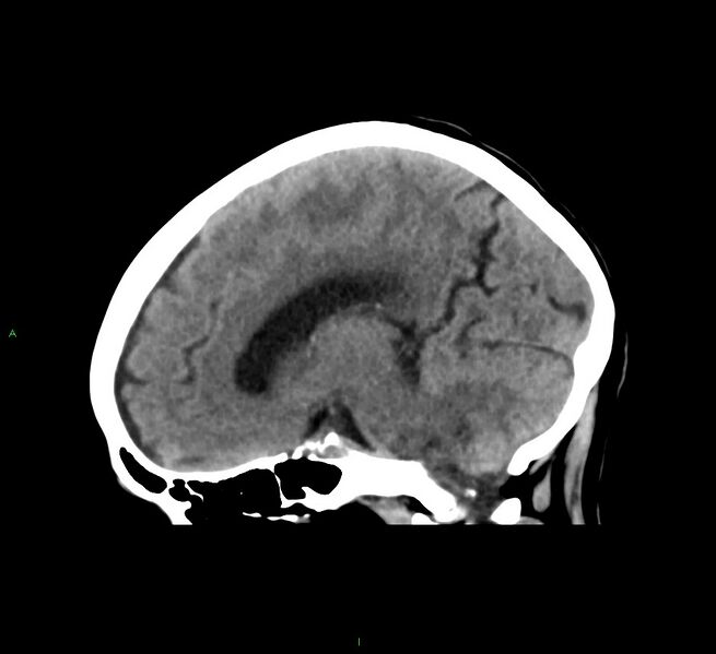 File:Cerebral amyloid angiopathy-associated lobar intracerebral hemorrhage (Radiopaedia 58563-65727 C 31).jpg