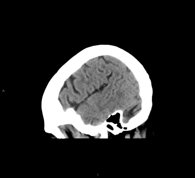 File:Cerebral amyloid angiopathy-associated lobar intracerebral hemorrhage (Radiopaedia 58563-65727 C 43).jpg