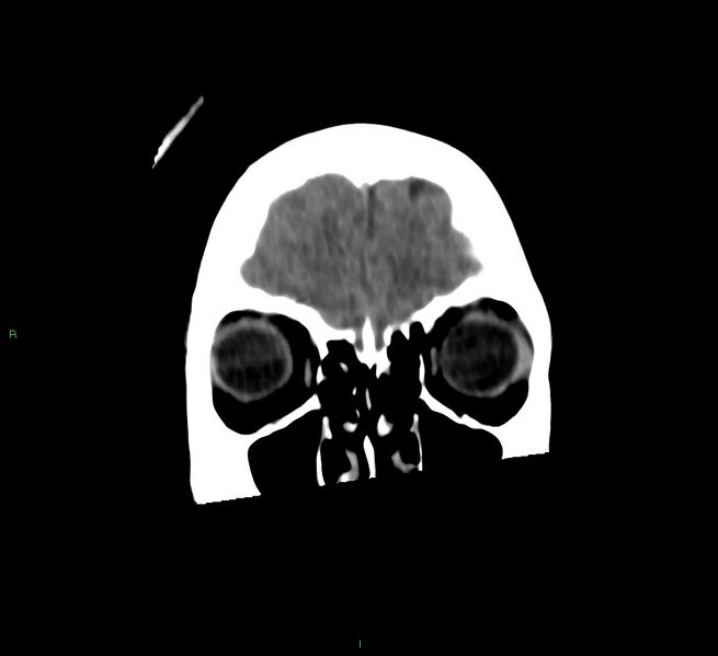 File:Cerebral amyloid angiopathy-associated lobar intracerebral hemorrhage (Radiopaedia 58566-65730 Coronal non-contrast 58).jpg