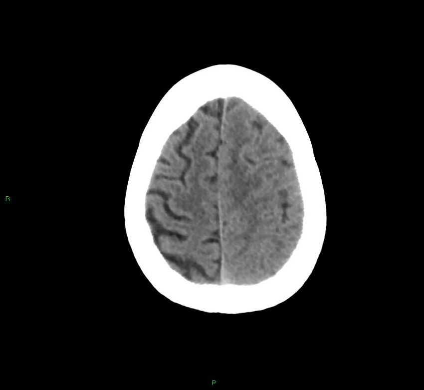 Cerebral amyloid angiopathy-associated lobar intracerebral hemorrhage (Radiopaedia 58754-65975 Axial non-contrast 18).jpg