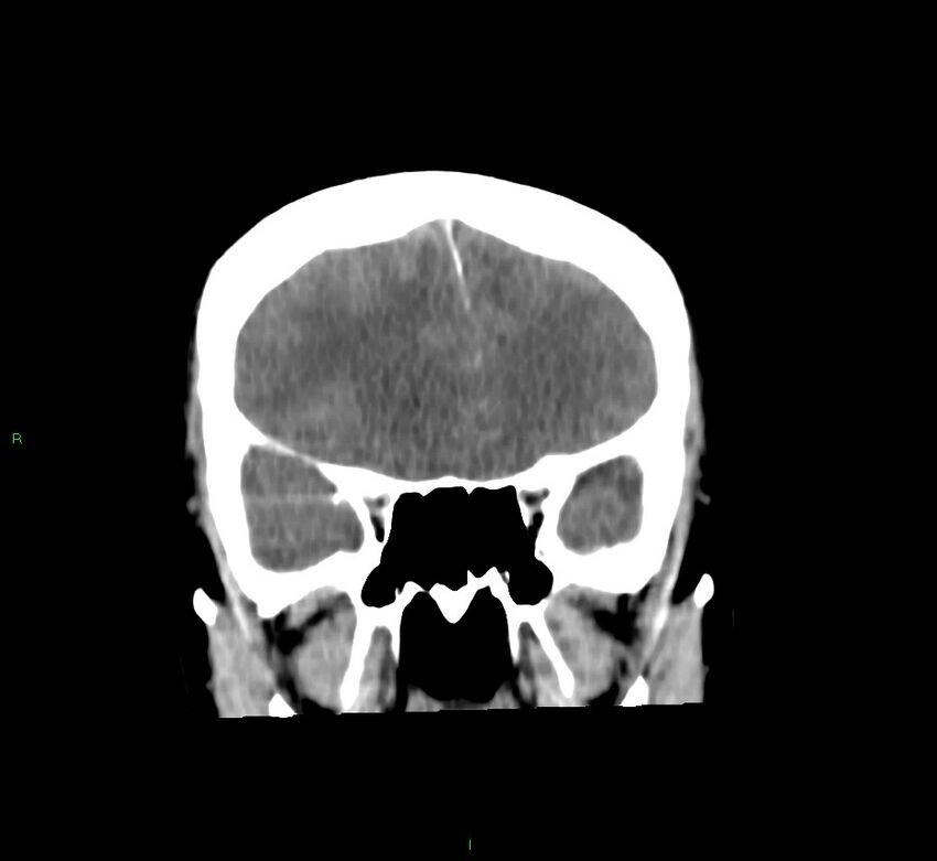 Cerebral amyloid angiopathy-associated lobar intracerebral hemorrhage (Radiopaedia 58756-65977 Coronal non-contrast 46).jpg