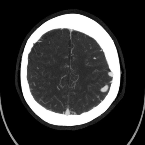 File:Cerebral arteriovenous malformation (Radiopaedia 43729-47189 B 39).jpg