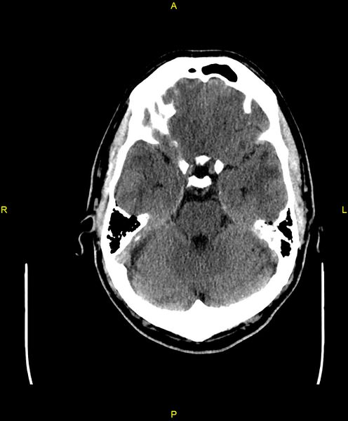 File:Cerebral autosomal dominant arteriopathy with subcortical infarcts and leukoencephalopathy (CADASIL) (Radiopaedia 86108-102051 Axial non-contrast 33).jpg