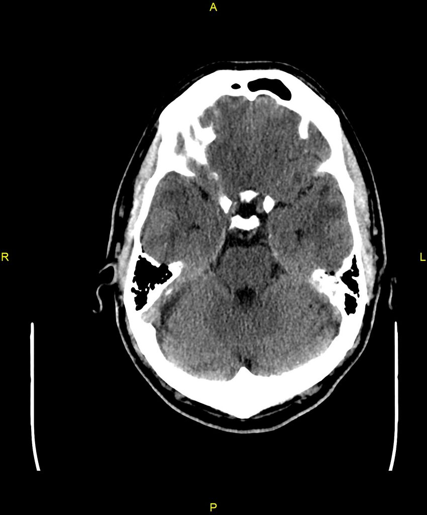 Cerebral autosomal dominant arteriopathy with subcortical infarcts and leukoencephalopathy (CADASIL) (Radiopaedia 86108-102051 Axial non-contrast 33).jpg