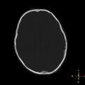 Cerebral contusion (Radiopaedia 48869-53911 Axial bone window 12).jpg