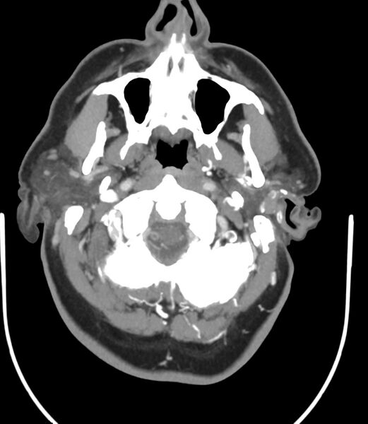 File:Cerebral dural venous sinus thrombosis (Radiopaedia 86514-102576 A 22).jpg