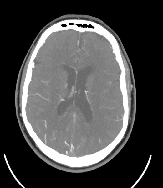 File:Cerebral dural venous sinus thrombosis (Radiopaedia 86514-102576 A 63).jpg