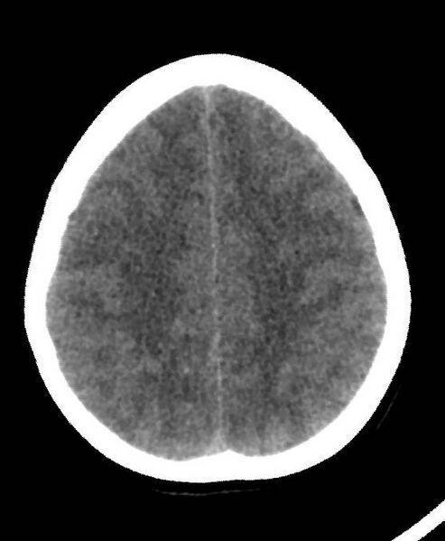 File:Cerebral edema due to severe hyponatremia (Radiopaedia 89826-106937 Axial non-contrast 70).jpg