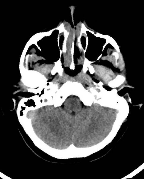 File:Cerebral edema due to severe hyponatremia (Radiopaedia 89826-106938 Axial non-contrast 21).jpg