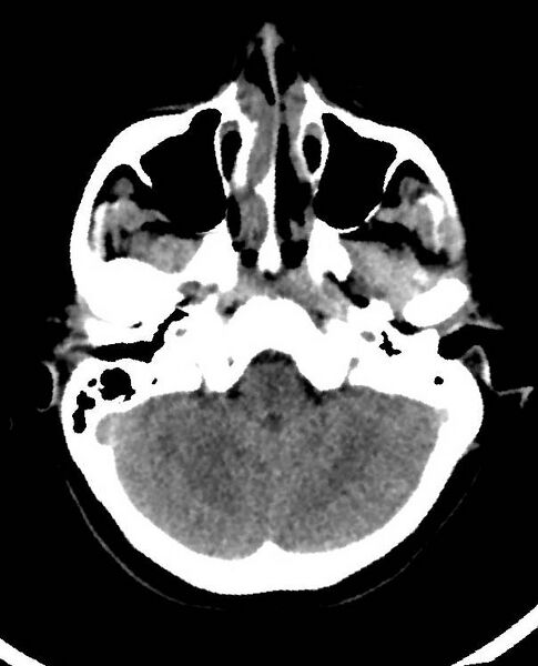 File:Cerebral edema due to severe hyponatremia (Radiopaedia 89826-106938 Axial non-contrast 22).jpg
