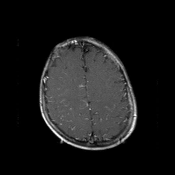 File:Cerebral tuberculoma (Radiopaedia 41152-43932 Axial T1 C+ 18).jpg