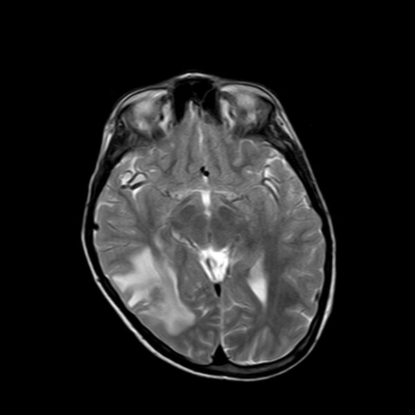 File:Cerebral tuberculoma (Radiopaedia 41152-43932 Axial T2 10).jpg