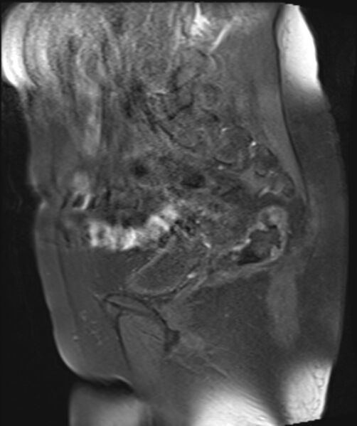 File:Cervical carcinoma (Radiopaedia 88312-104943 Sagittal T1 fat sat 12).jpg