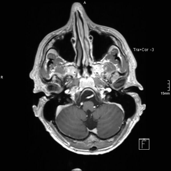 File:Cervical dural CSF leak on MRI and CT treated by blood patch (Radiopaedia 49748-54995 Axial T1 C+ 21).jpg