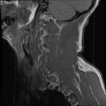 Cervical flexion teardrop fracture with cord hemorrhage (Radiopaedia 32497-33455 Sagittal T1 19).jpg